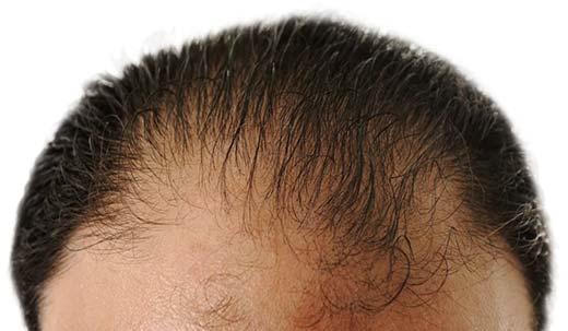 hair transplant service