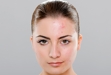 Acne scar treatment - Pimple Scar Removal Delhi