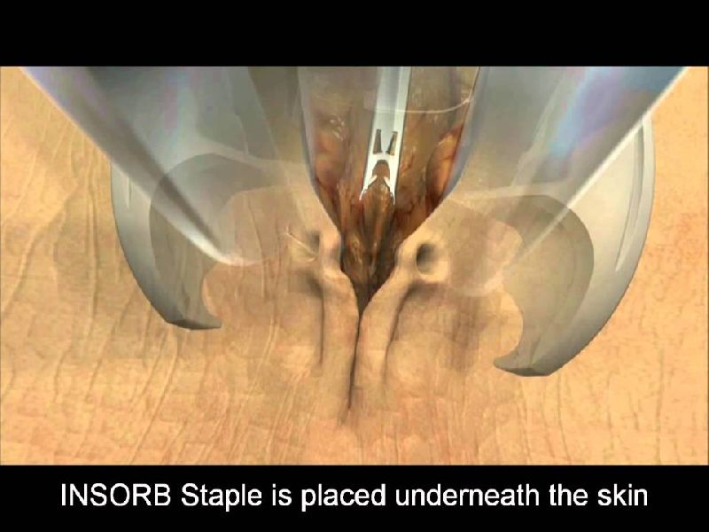 Insorb Absorbable Skin Stapler