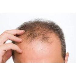 Hair Baldness Treatment