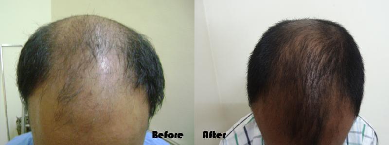 hair transplant cosmetic surgery
