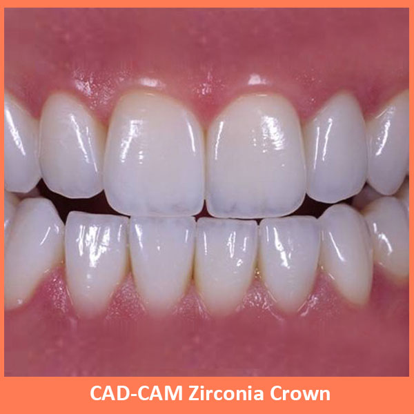 CAD-CAM Zirconia Crown
