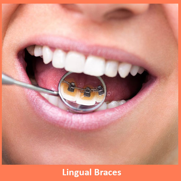 Lingual Braces