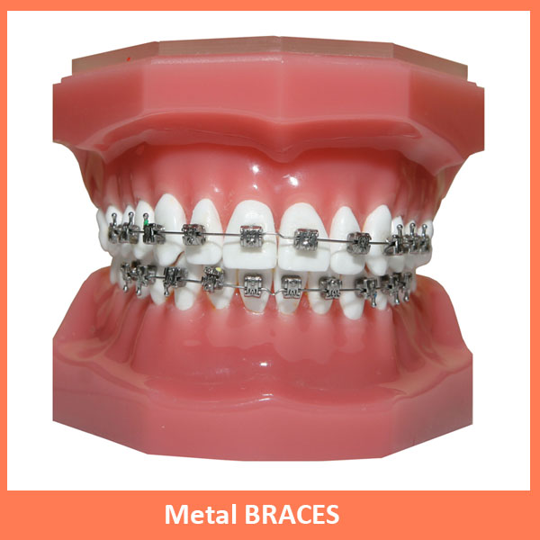 metal braces