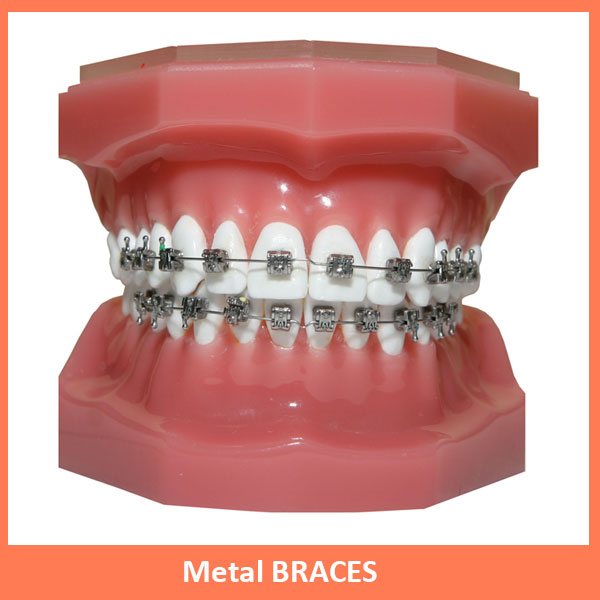 Metal braces