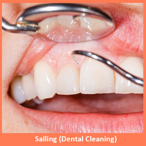 Salling Dental Cleaning