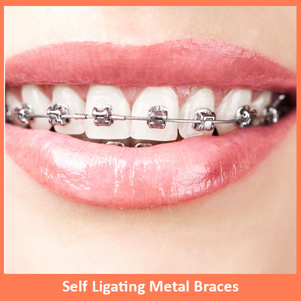 Self Ligating Metal Braces