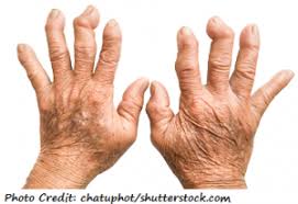 Rheumatoid arthritis