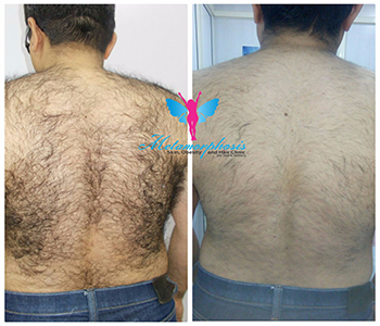 laser hair removal treatment - Metamorphosis Clinic, Delhi, Delhi