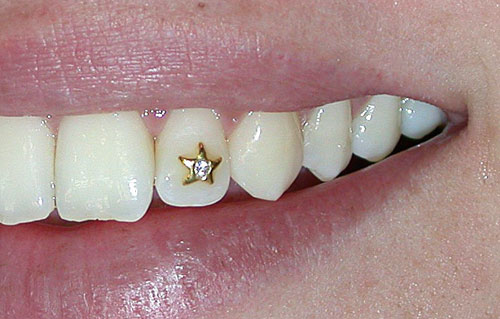 dental jewellery