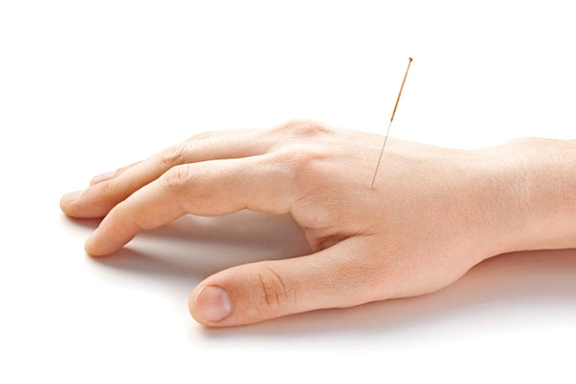 Acupuncture Treatment Services
