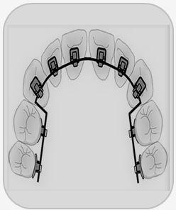 LINGUAL ARCH WIRES