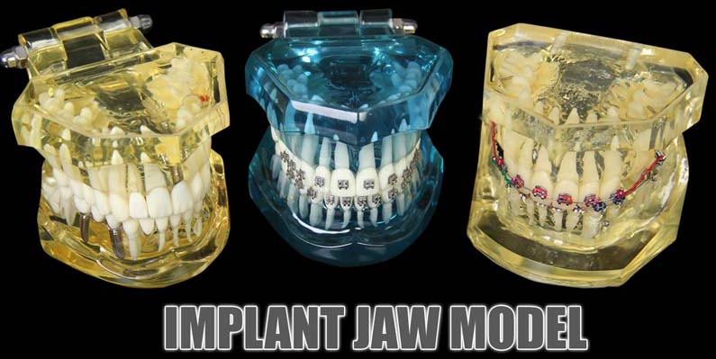Implant Jaw Model