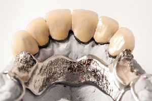 Cast Metal-Based Dentures