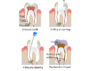 Root canal Treatment in Coimbatore
