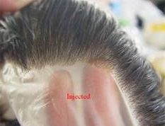 Injected Hair System