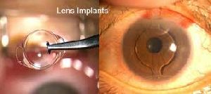 Optical Eye Lens