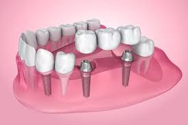 Dental implants