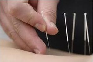 Acupuncture Tube Needle