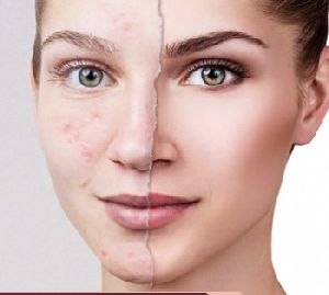 acne scar treatment services