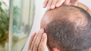 Stem Cell Therapy for Hair Loss