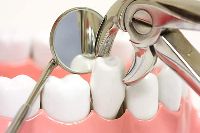 Tooth Extraction Treatment Services