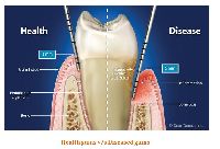 Gum Disease Treatment Services