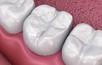 Pit And Fissure Sealants Treatment Services
