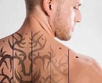 Tattoo Removal Treatment Service