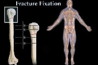 Fracture Fixtation Treatment