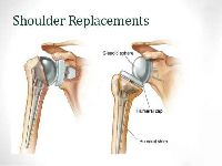 Shoulder Replacement Treatment Surgery