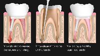 Re - Root Canal Therapy