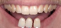 Tooth Coloured Restorations