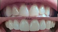 dental veneers treatment