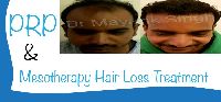PRP &amp; Mesotherapy Hair Loss Treatment Services