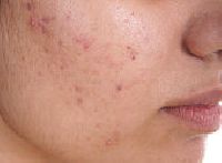 Acne Homeopathic Treatment Services