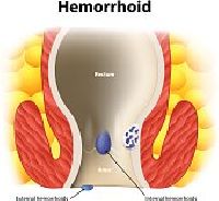 Hemorrhoids Homeopathic Treatment Services