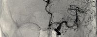 Angiography in India