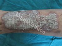 Dermatology Skin Treatment
