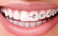 Orthodontic Treatment and Aligner Services