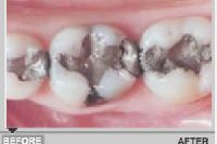 Teeth White Fillings Services