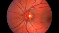 Optic Neuropathy Stem Cell Treatment Services