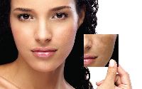 Melasma Laser Treatment