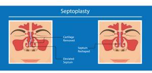 Septoplasty Surgery Treatment Services