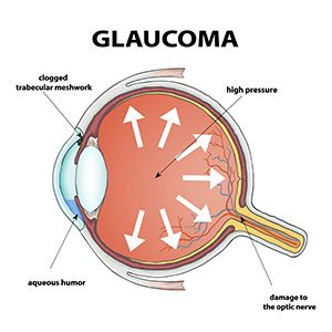 Glaucoma Treatment