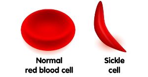 Sickle Cell Anemia Treatment