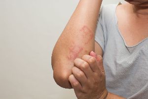 eczema treatment services