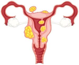 fibroid treatment