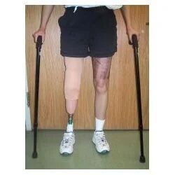 Below Knee Artificial Limbs