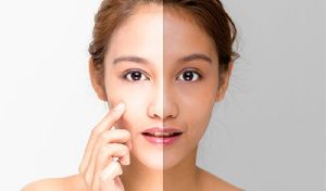 Skin Whitening Treatment